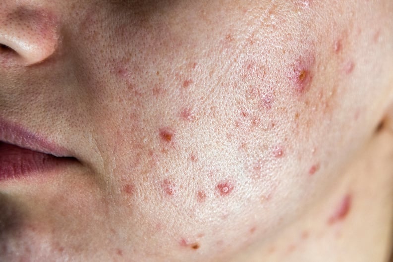 Closeup of woman face with bad skin and red acne